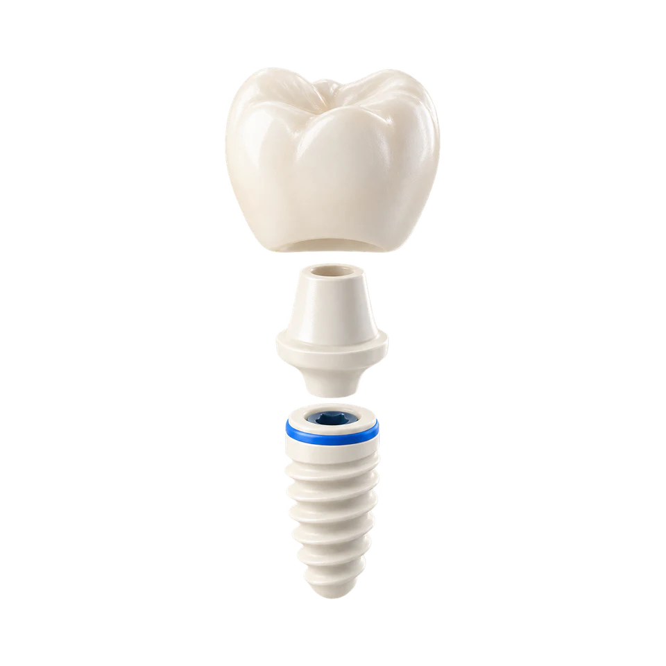 Illustration d’un implant dentaire, de son pilier et de sa couronne.